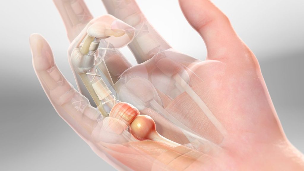 Tenosivitis atau Trigger Finger